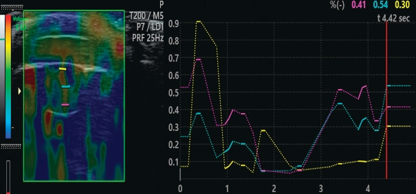 Рис. 1. Эталон оценки помутнения слоев хрусталика по классификации LOCS III Рис. 1. Эталон оценки помутнения слоев хрусталика по классификации LOCS III