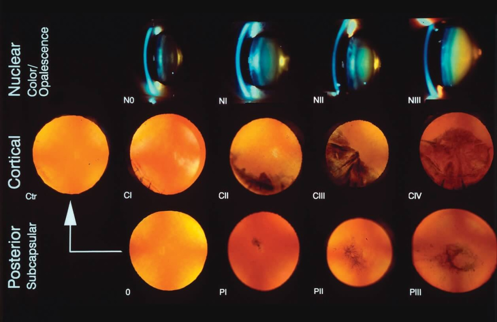 Рис. 2. Соноэластография хрусталика с диффузными помутнениями передней капсулы и ядра Рис. 2. Соноэластография хрусталика с диффузными помутнениями передней капсулы и ядра